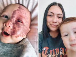 Mom Who Got Teased For Lasering A Big Birthmark On Her Baby's Face Explains Why She Did It